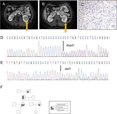 Concurrent Germline and Somatic Mutations in FLCN and Preliminary Exploration of Its Function: A Case Report